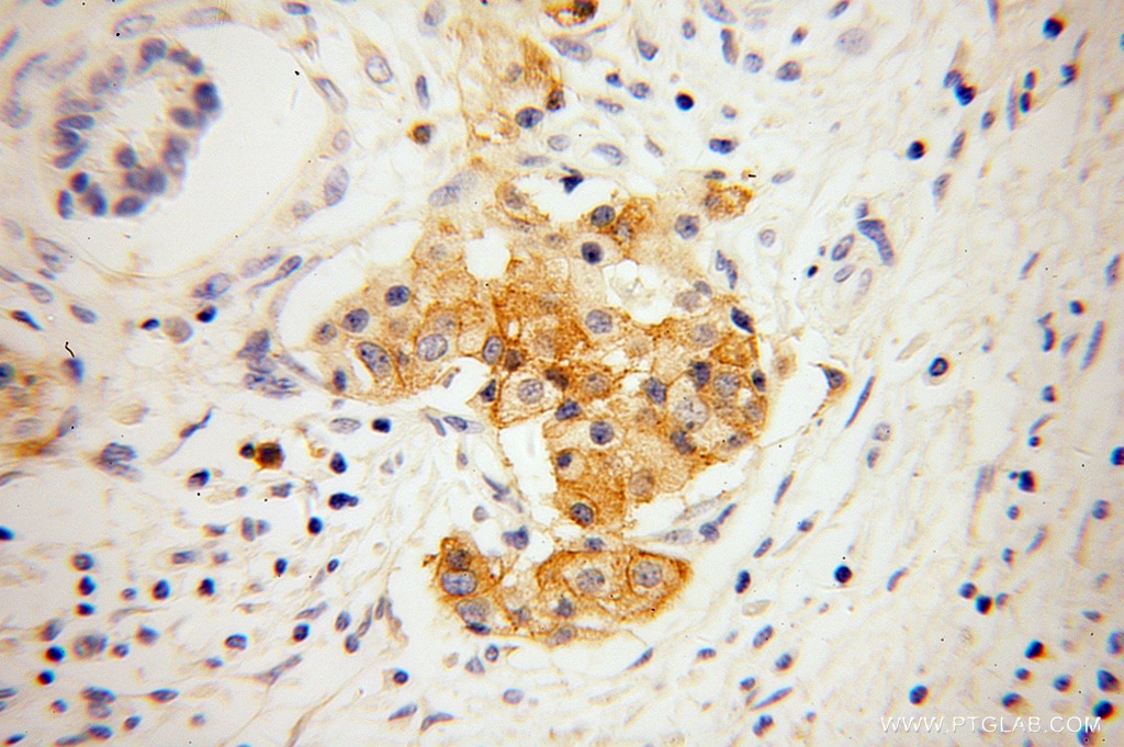 IHC staining of human pancreas cancer using 13780-1-AP