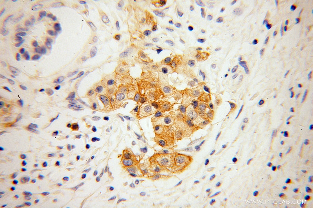 Immunohistochemistry (IHC) staining of human pancreas cancer tissue using GNG4 Polyclonal antibody (13780-1-AP)