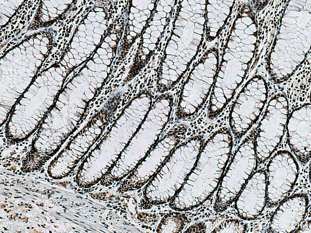 IHC staining of human colon cancer using 15060-1-AP