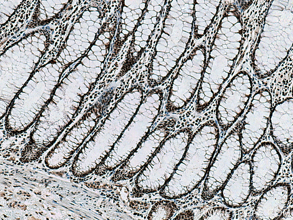 Immunohistochemistry (IHC) staining of human colon cancer tissue using GNL3 Polyclonal antibody (15060-1-AP)