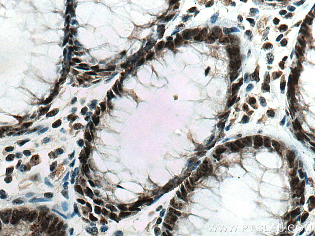 Immunohistochemistry (IHC) staining of human colon cancer tissue using GNL3 Polyclonal antibody (15060-1-AP)