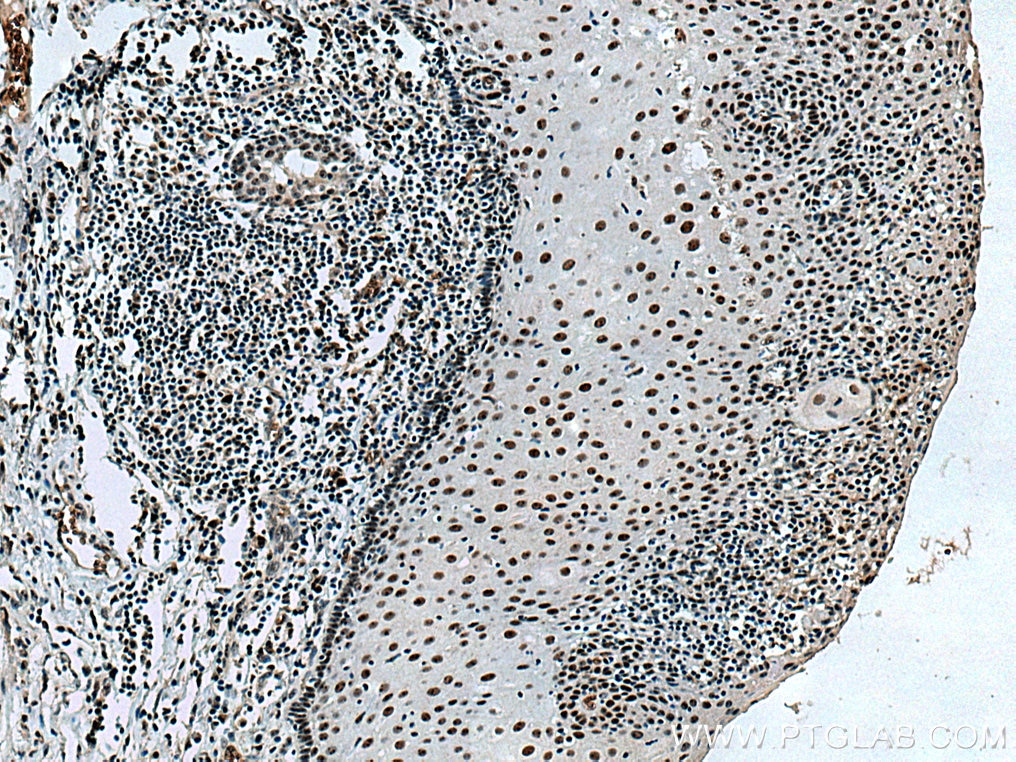 Immunohistochemistry (IHC) staining of human oesophagus cancer tissue using GNL3 Polyclonal antibody (15060-1-AP)