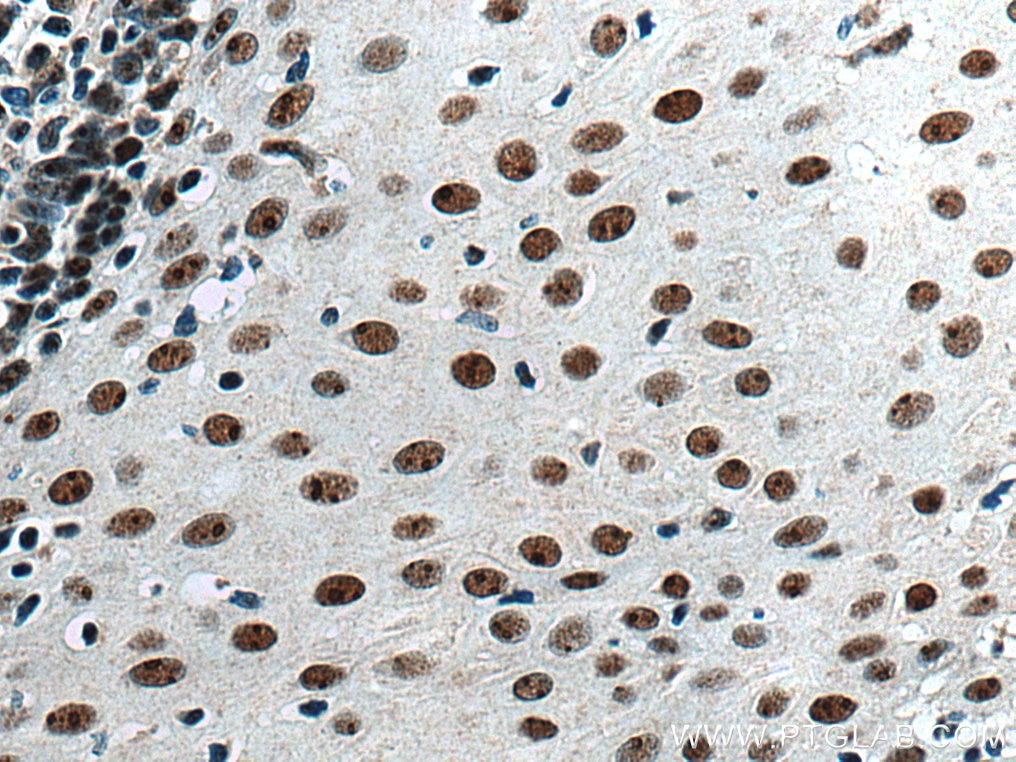 Immunohistochemistry (IHC) staining of human oesophagus cancer tissue using GNL3 Polyclonal antibody (15060-1-AP)