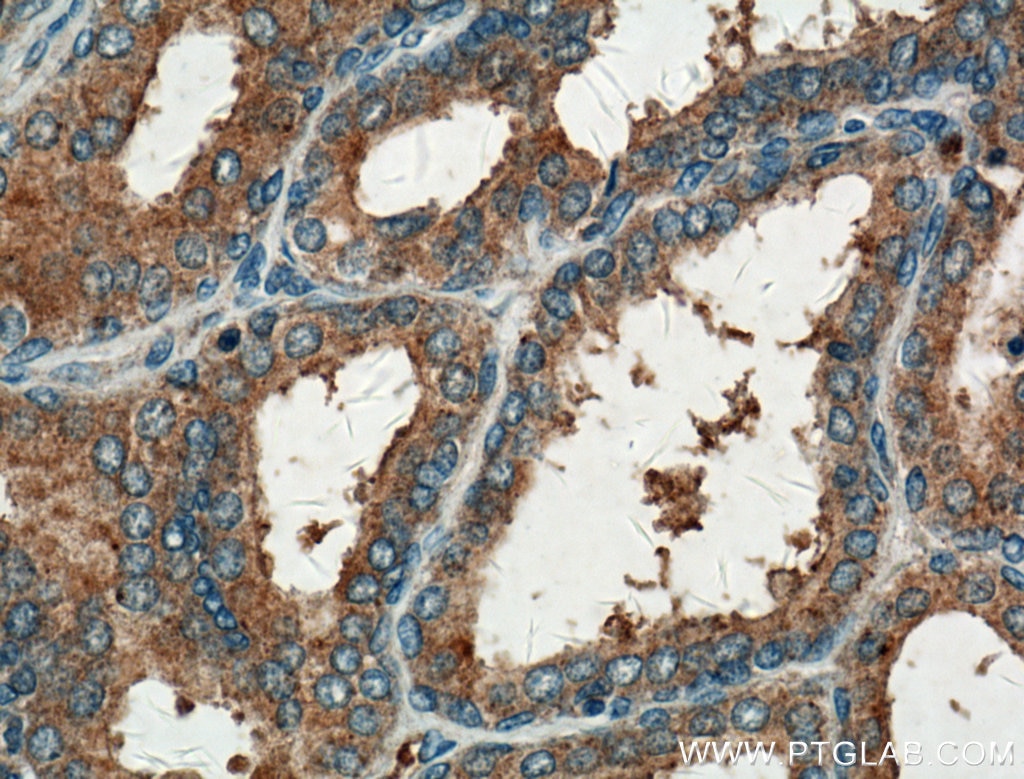 Immunohistochemistry (IHC) staining of human prostate hyperplasia tissue using GNMT Polyclonal antibody (18790-1-AP)