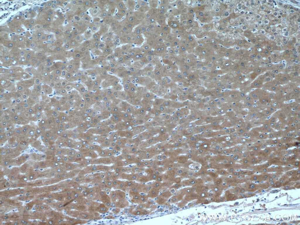 Immunohistochemistry (IHC) staining of human liver cancer tissue using GNMT Polyclonal antibody (18790-1-AP)