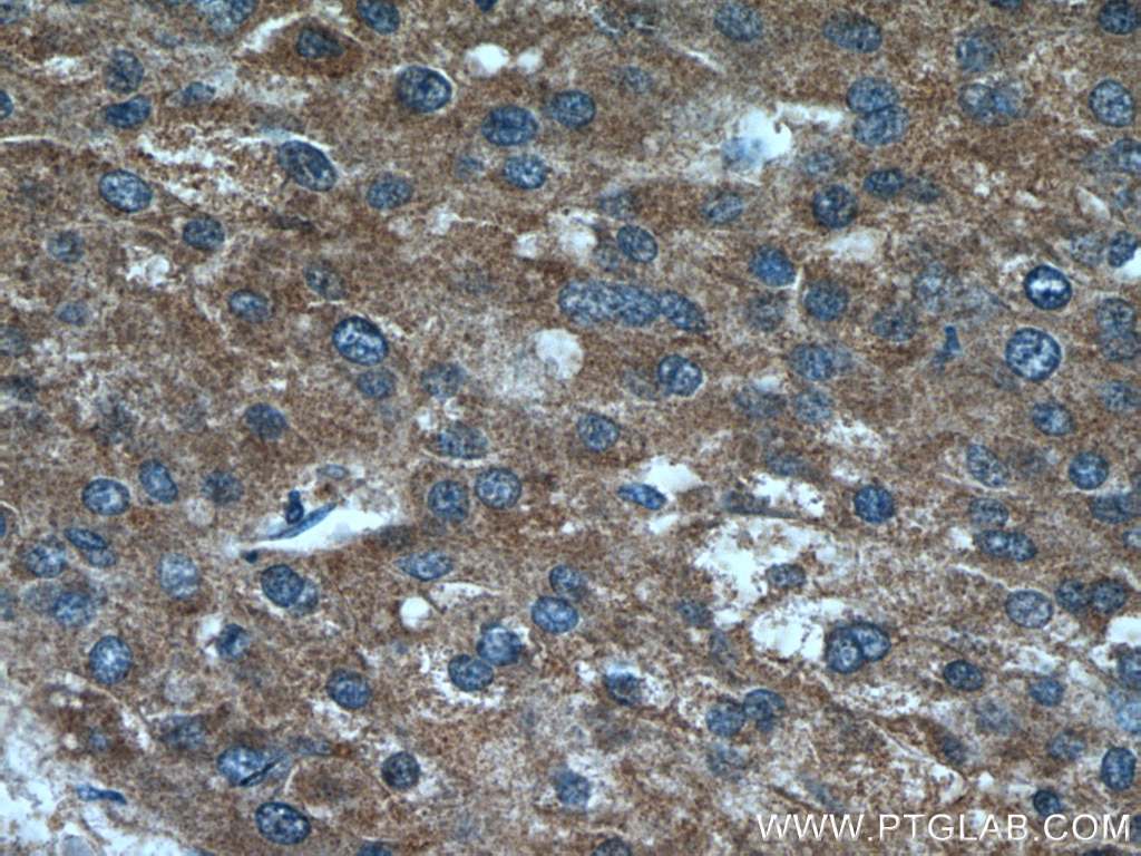 Immunohistochemistry (IHC) staining of human liver cancer tissue using GNMT Polyclonal antibody (18790-1-AP)