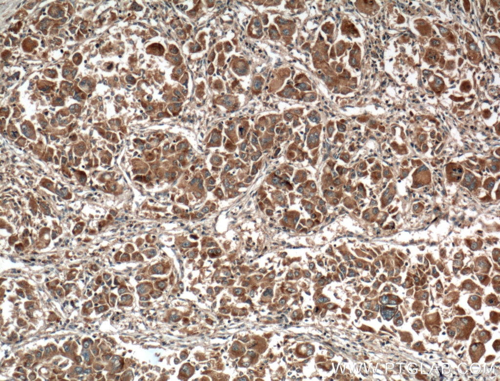 Immunohistochemistry (IHC) staining of human liver cancer tissue using GNPAT Monoclonal antibody (66453-1-Ig)