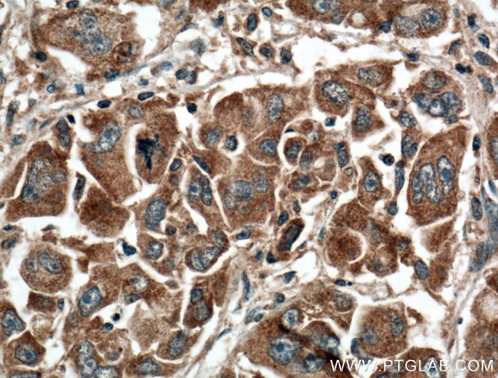 Immunohistochemistry (IHC) staining of human liver cancer tissue using GNPAT Monoclonal antibody (66453-1-Ig)