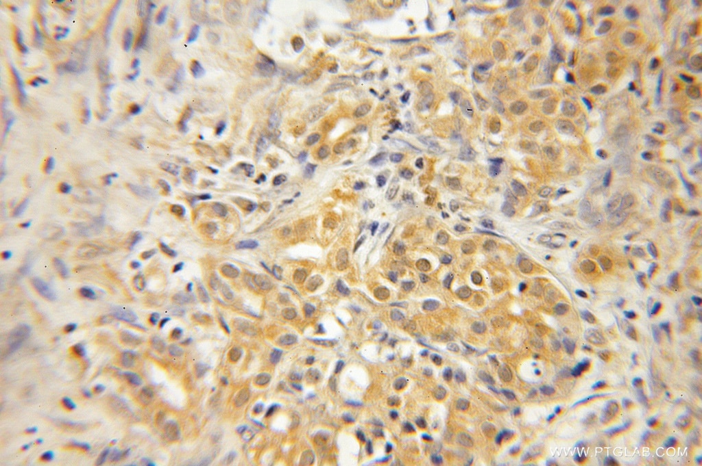 Immunohistochemistry (IHC) staining of human pancreas cancer tissue using GNPDA1 Polyclonal antibody (12312-1-AP)