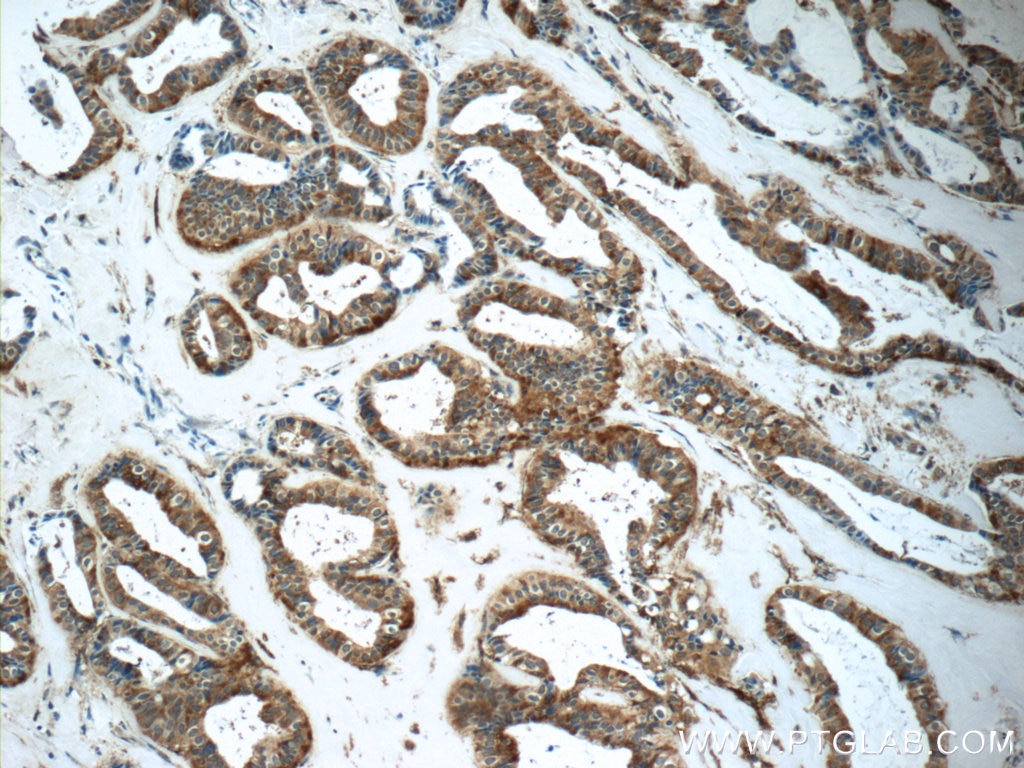 Immunohistochemistry (IHC) staining of human breast cancer tissue using GNPDA2 Polyclonal antibody (17105-1-AP)