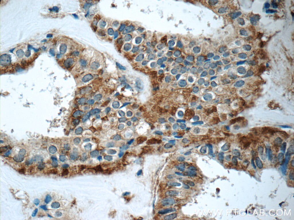 Immunohistochemistry (IHC) staining of human breast cancer tissue using GNPDA2 Polyclonal antibody (17105-1-AP)