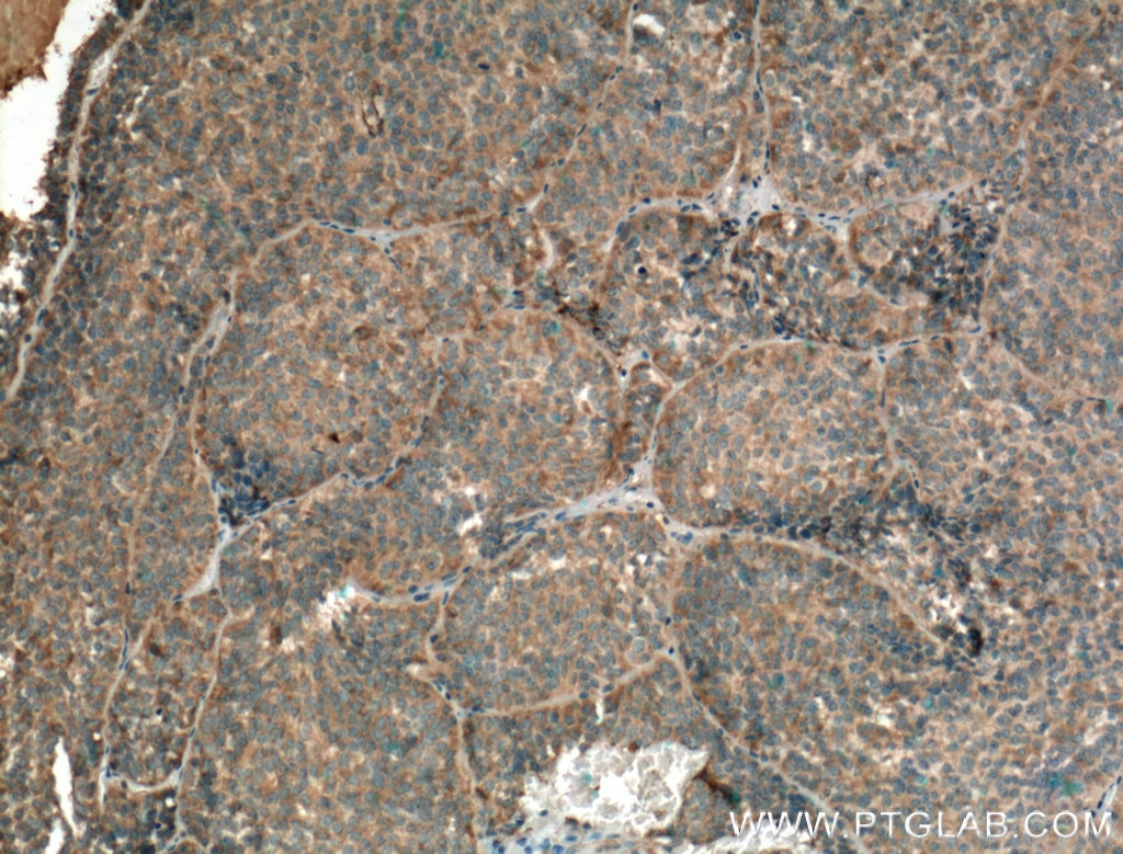 Immunohistochemistry (IHC) staining of human pituitary adenoma tissue using GNRHR Polyclonal antibody (22462-1-AP)