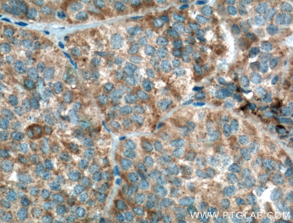 Immunohistochemistry (IHC) staining of human pituitary adenoma tissue using GNRHR Polyclonal antibody (22462-1-AP)