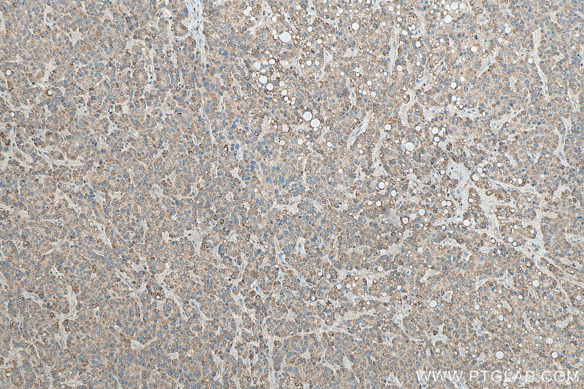 IHC staining of human liver cancer using 20728-1-AP