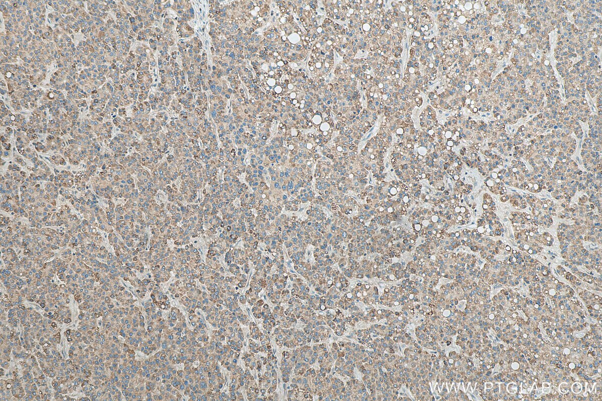 Immunohistochemistry (IHC) staining of human liver cancer tissue using GNRHR2 Polyclonal antibody (20728-1-AP)