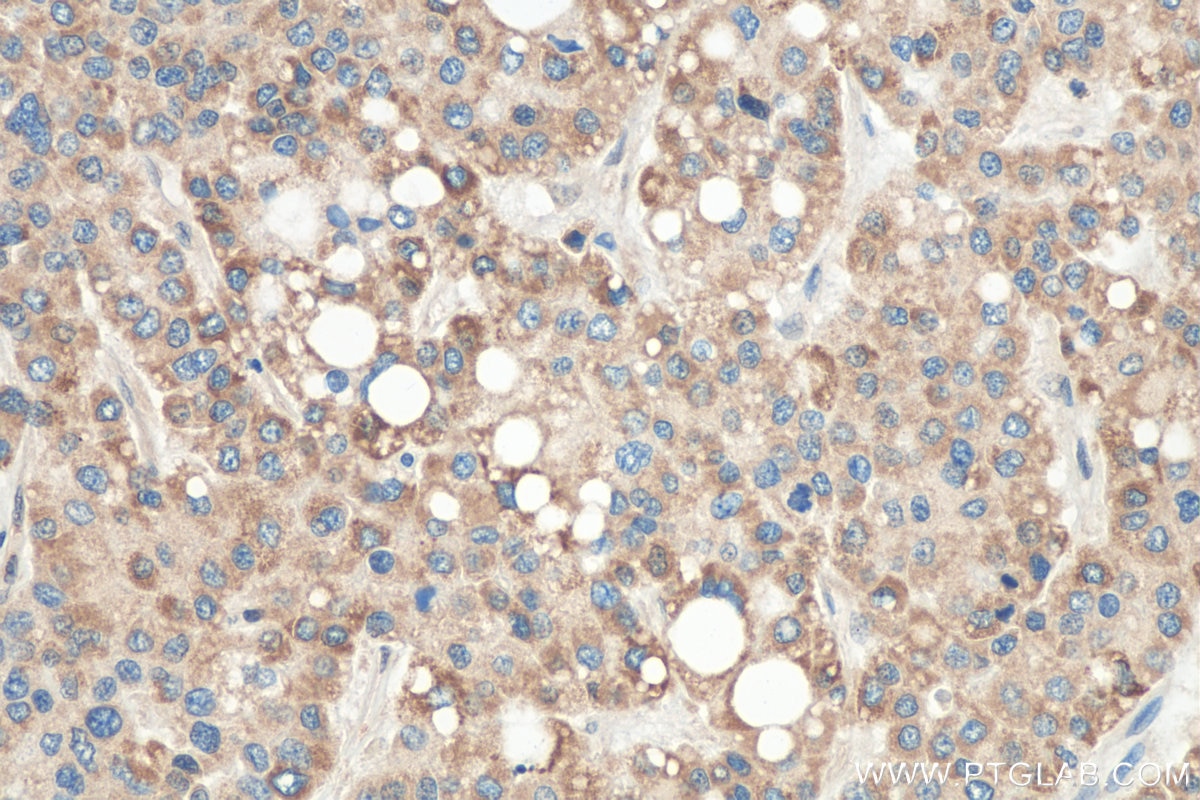 Immunohistochemistry (IHC) staining of human liver cancer tissue using GNRHR2 Polyclonal antibody (20728-1-AP)