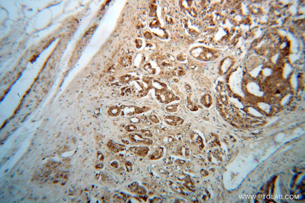 Immunohistochemistry (IHC) staining of human prostate cancer tissue using GNS Polyclonal antibody (13044-1-AP)