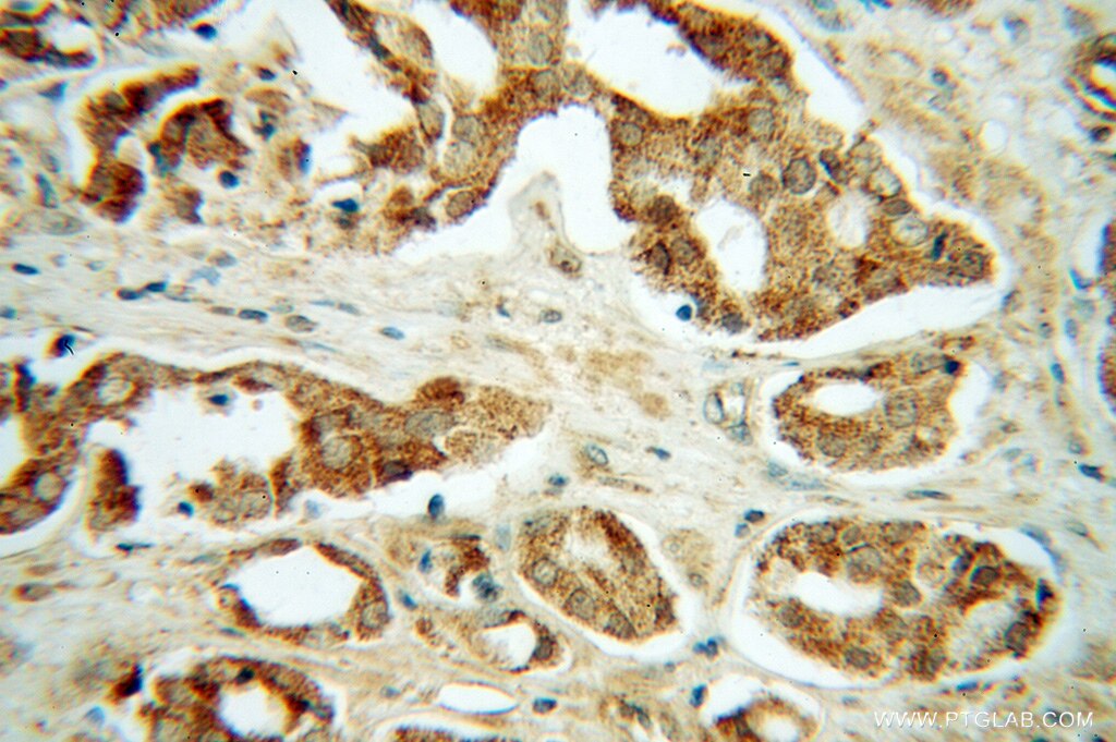 Immunohistochemistry (IHC) staining of human prostate cancer tissue using GNS Polyclonal antibody (13044-1-AP)