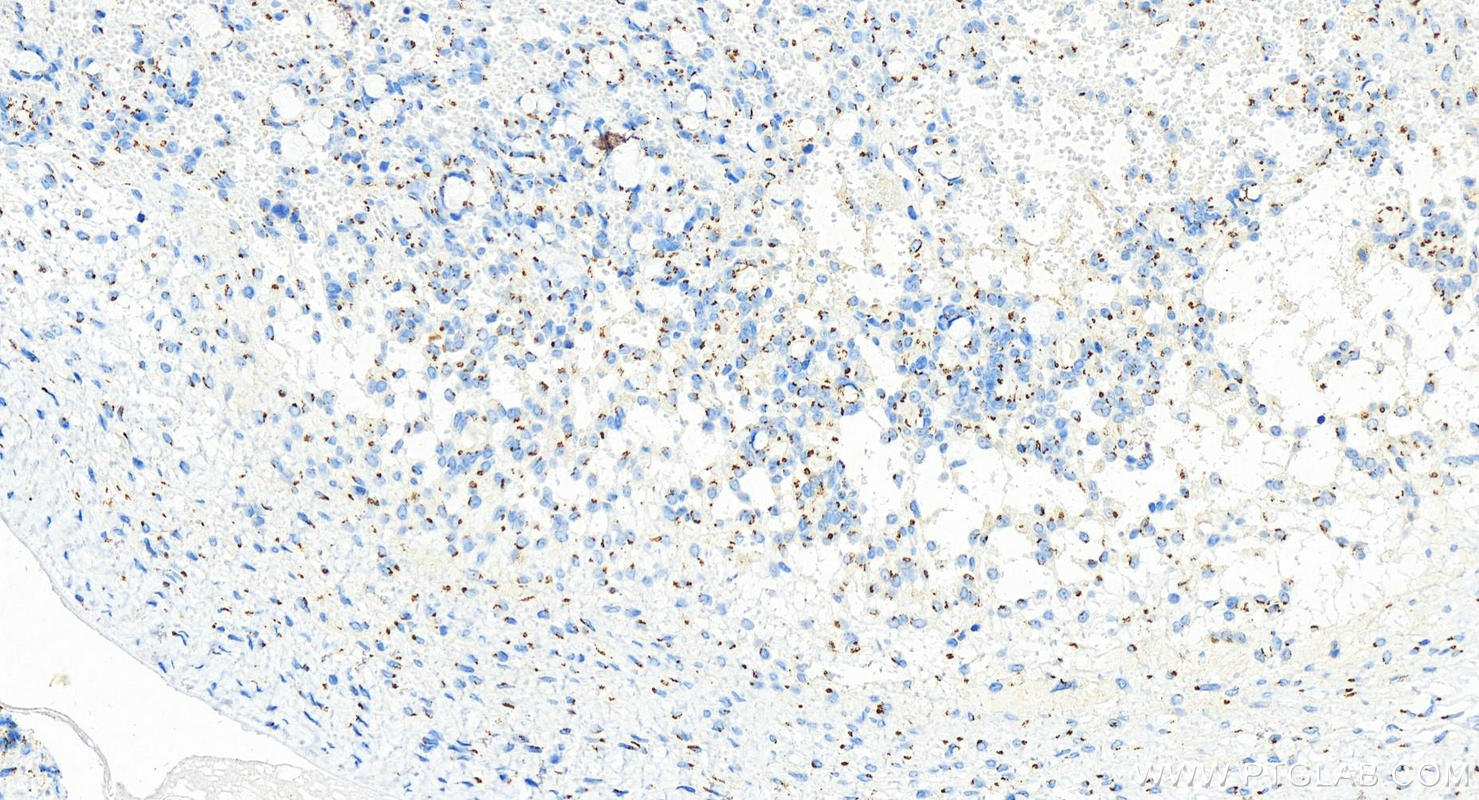 Immunohistochemistry (IHC) staining of human ovary cancer tissue using GOLGA5 Recombinant antibody (83839-2-RR)