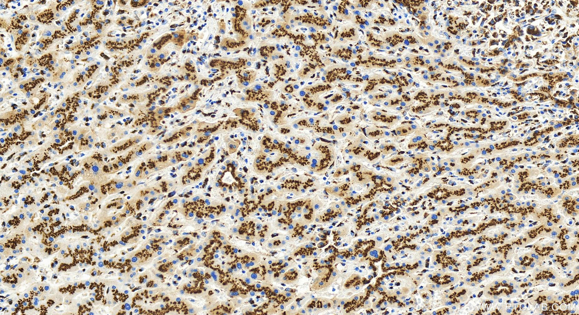 Immunohistochemistry (IHC) staining of human intrahepatic cholangiocarcinoma tissue using GOLIM4 Polyclonal antibody (31083-1-AP)