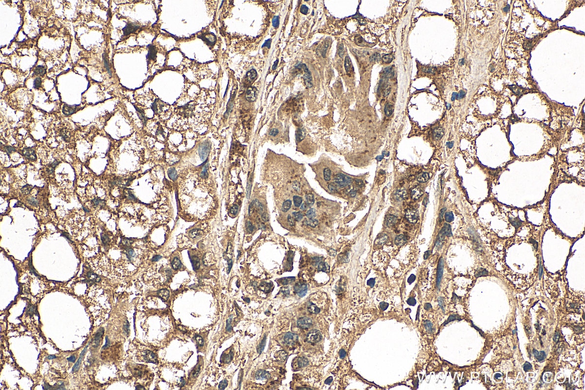 Immunohistochemistry (IHC) staining of human liver cancer tissue using GP73/GOLPH2 Polyclonal antibody (15126-1-AP)