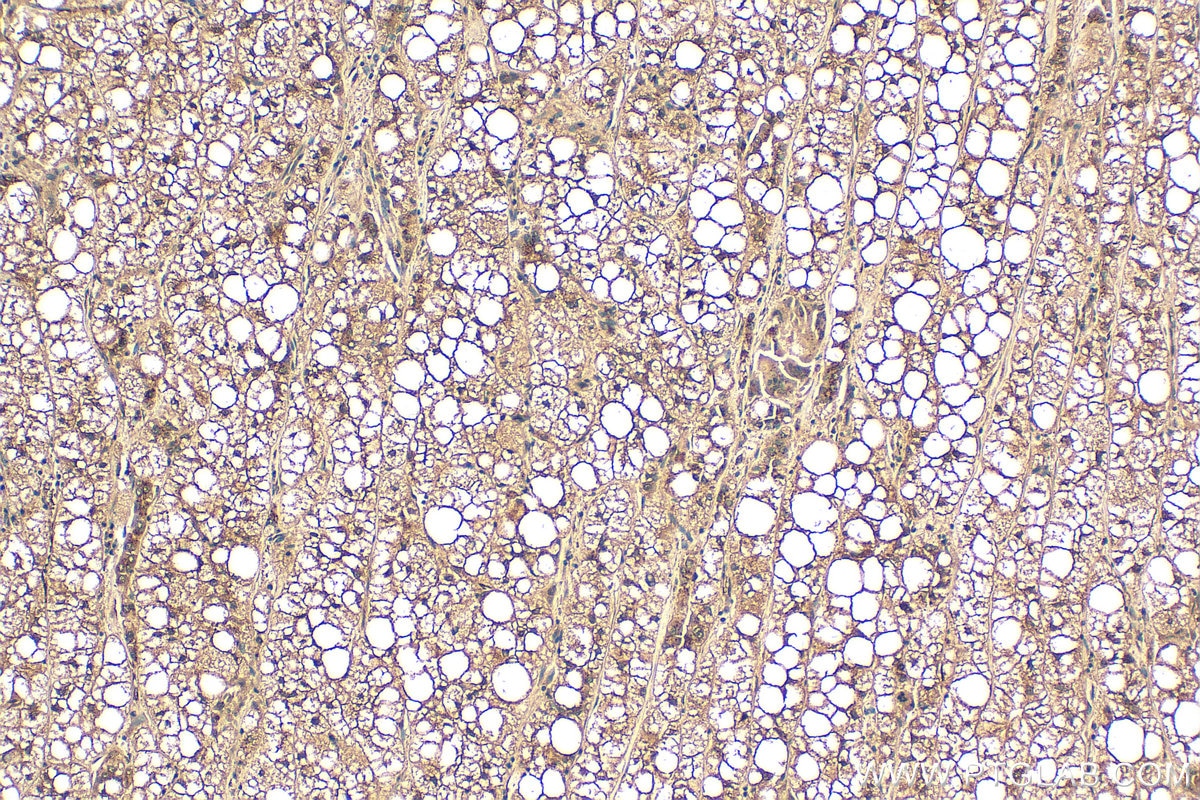 Immunohistochemistry (IHC) staining of human liver cancer tissue using GP73/GOLPH2 Polyclonal antibody (15126-1-AP)