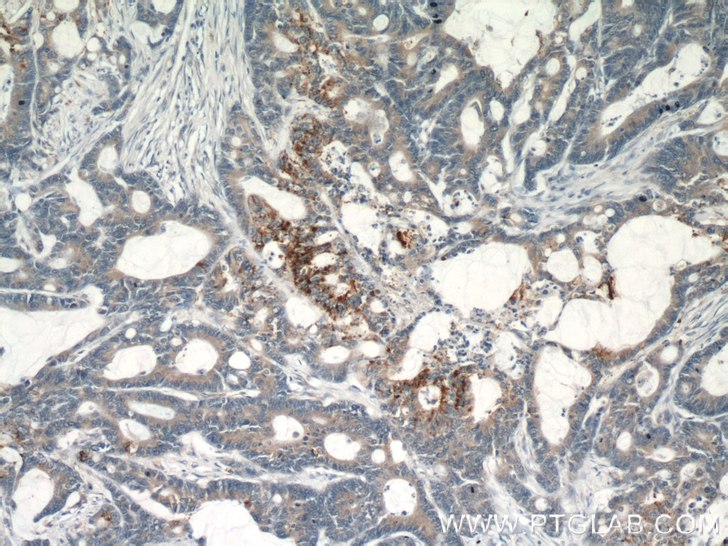 Immunohistochemistry (IHC) staining of human colon cancer tissue using GOLPH3 Polyclonal antibody (19112-1-AP)