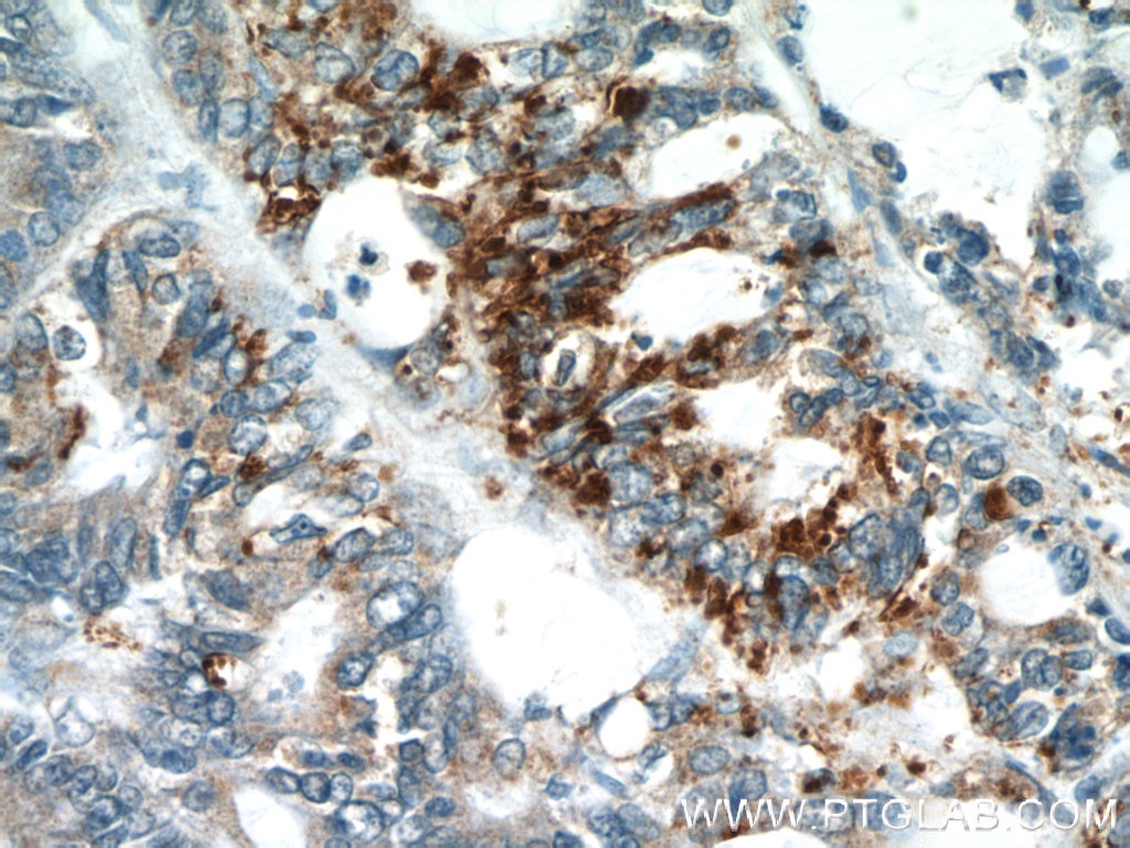 Immunohistochemistry (IHC) staining of human colon cancer tissue using GOLPH3 Polyclonal antibody (19112-1-AP)