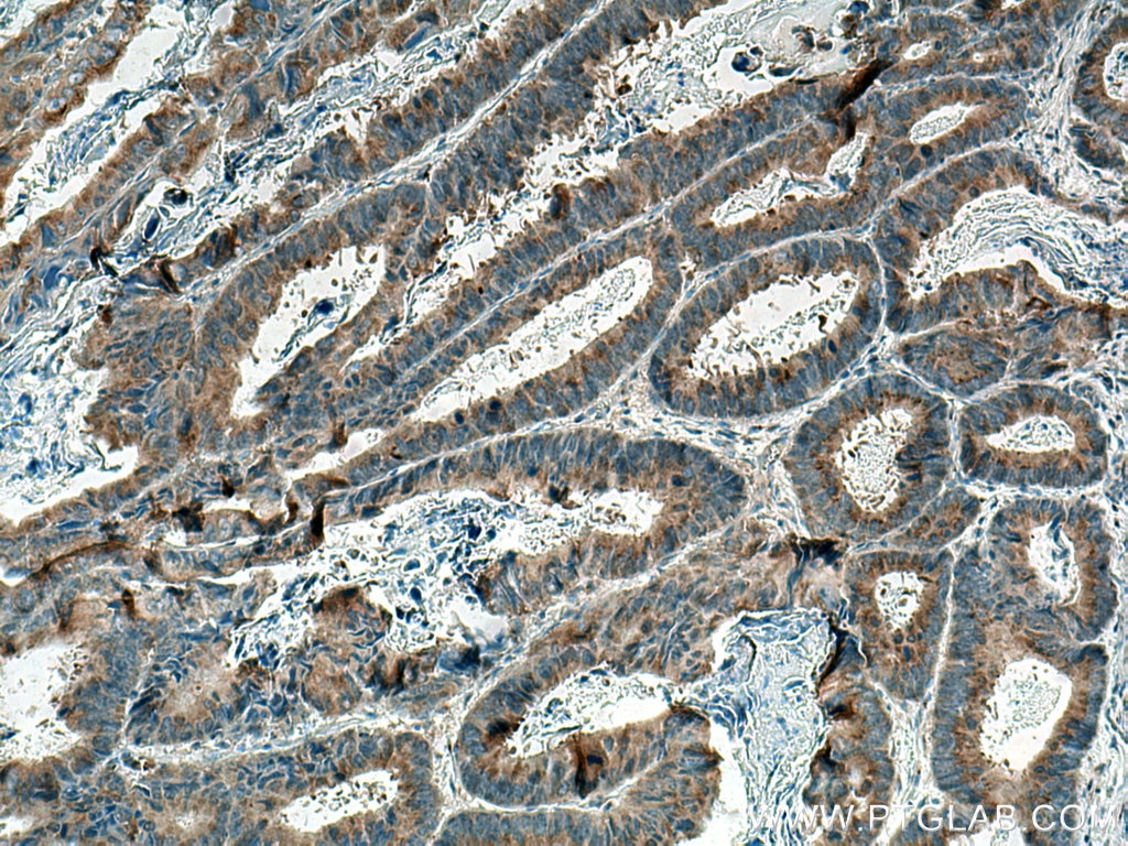 Immunohistochemistry (IHC) staining of human colon cancer tissue using GOLPH3 Monoclonal antibody (67777-1-Ig)