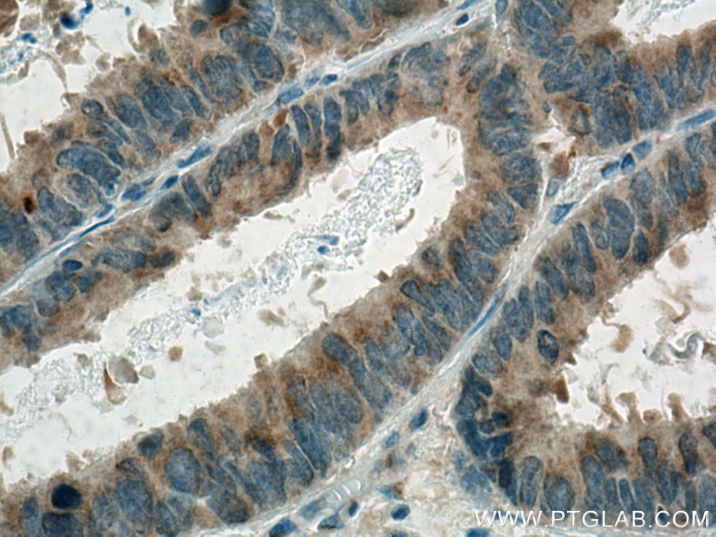 Immunohistochemistry (IHC) staining of human colon cancer tissue using GOLPH3 Monoclonal antibody (67777-1-Ig)