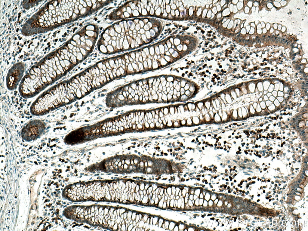 IHC staining of human colon cancer using 67777-1-Ig