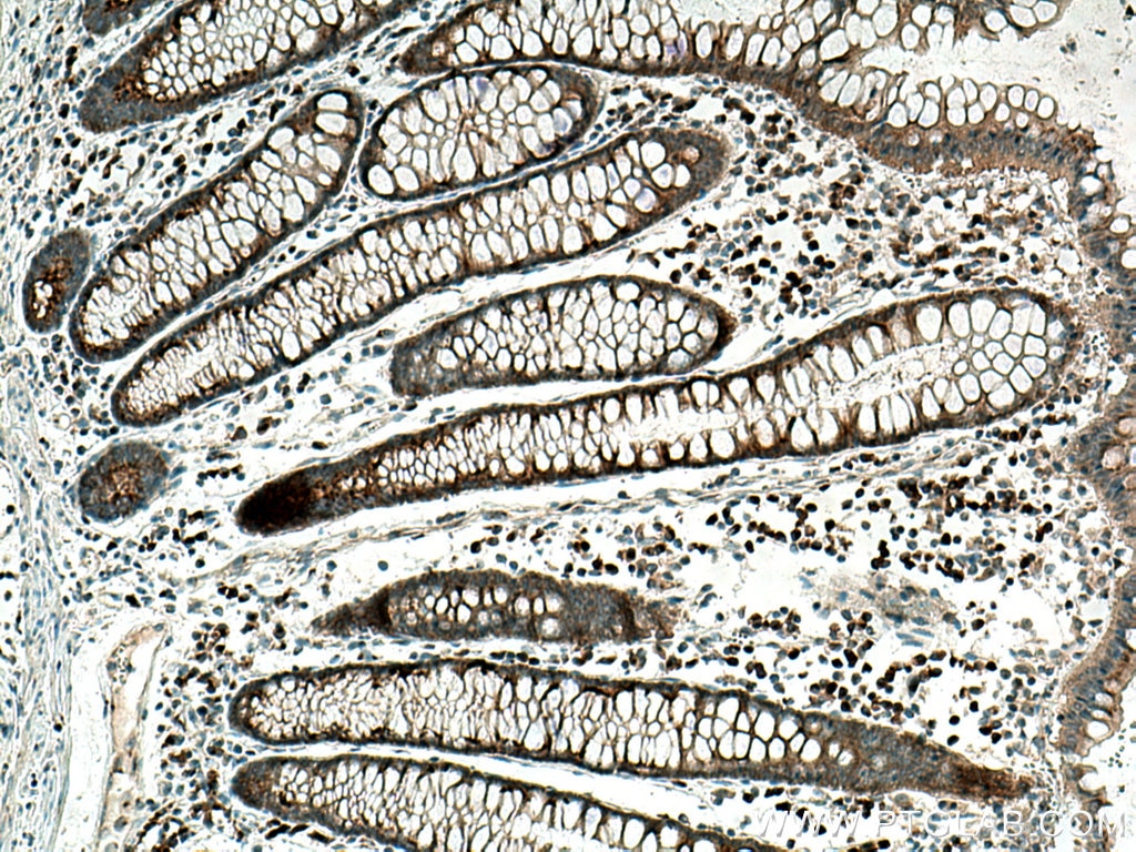 Immunohistochemistry (IHC) staining of human colon cancer tissue using GOLPH3 Monoclonal antibody (67777-1-Ig)