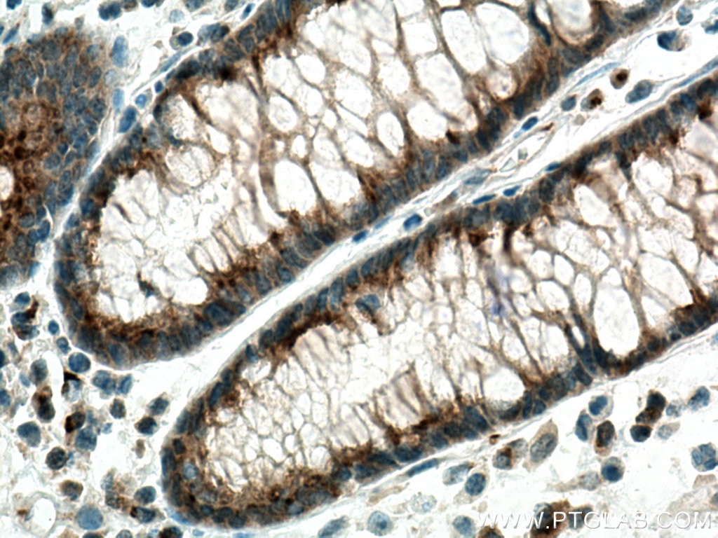 Immunohistochemistry (IHC) staining of human colon cancer tissue using GOLPH3 Monoclonal antibody (67777-1-Ig)