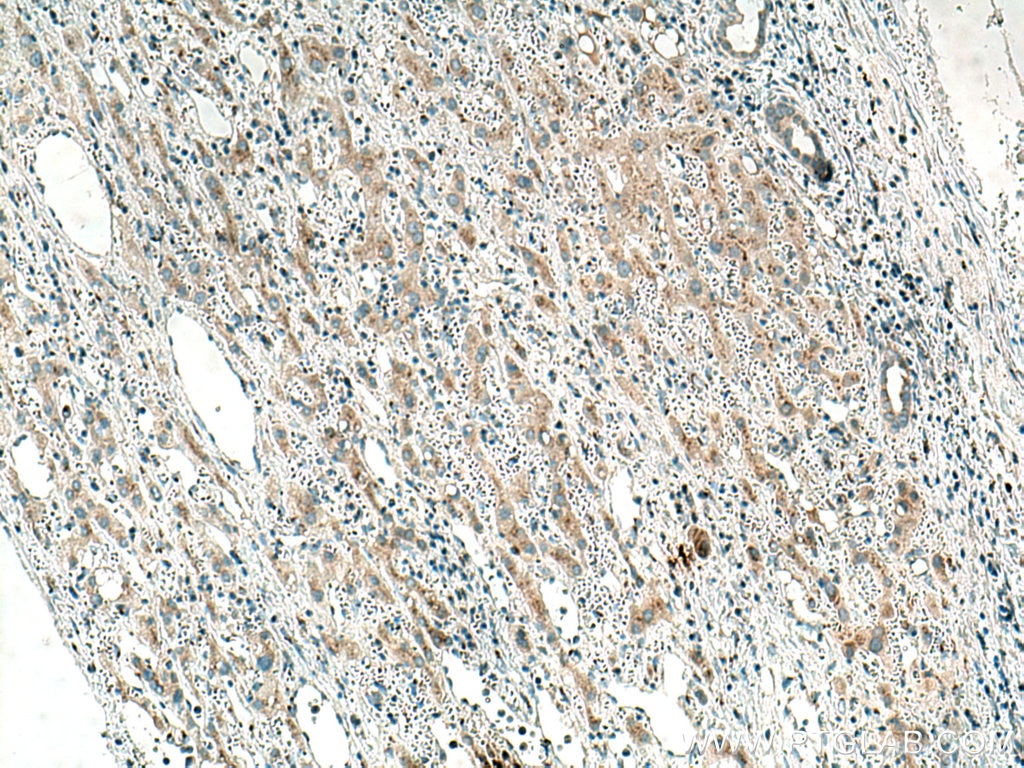 Immunohistochemistry (IHC) staining of human liver cancer tissue using GOLPH3 Monoclonal antibody (67777-1-Ig)