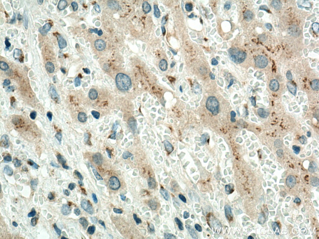 Immunohistochemistry (IHC) staining of human liver cancer tissue using GOLPH3 Monoclonal antibody (67777-1-Ig)