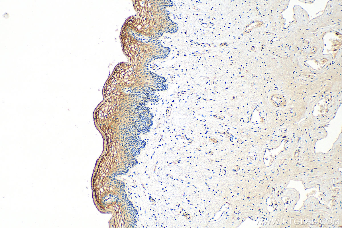 Immunohistochemistry (IHC) staining of human cervical cancer tissue using GOLPH3L Polyclonal antibody (23153-1-AP)