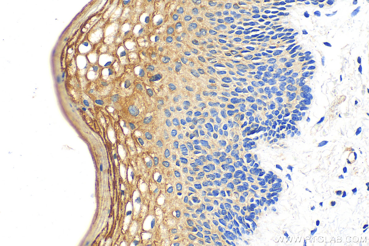 Immunohistochemistry (IHC) staining of human cervical cancer tissue using GOLPH3L Polyclonal antibody (23153-1-AP)