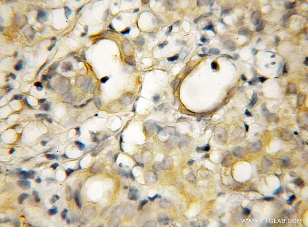 Immunohistochemistry (IHC) staining of human pancreas cancer tissue using GOPC Polyclonal antibody (12163-1-AP)