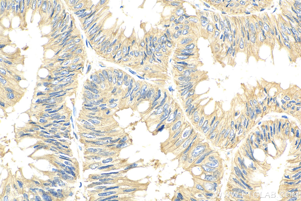 Immunohistochemistry (IHC) staining of human colon cancer tissue using GORASP2 Polyclonal antibody (10598-1-AP)