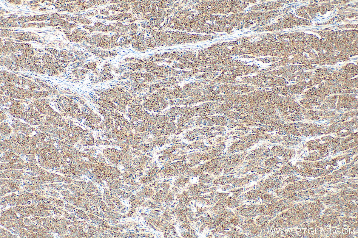 Immunohistochemistry (IHC) staining of human colon cancer tissue using GORASP2 Polyclonal antibody (10598-1-AP)