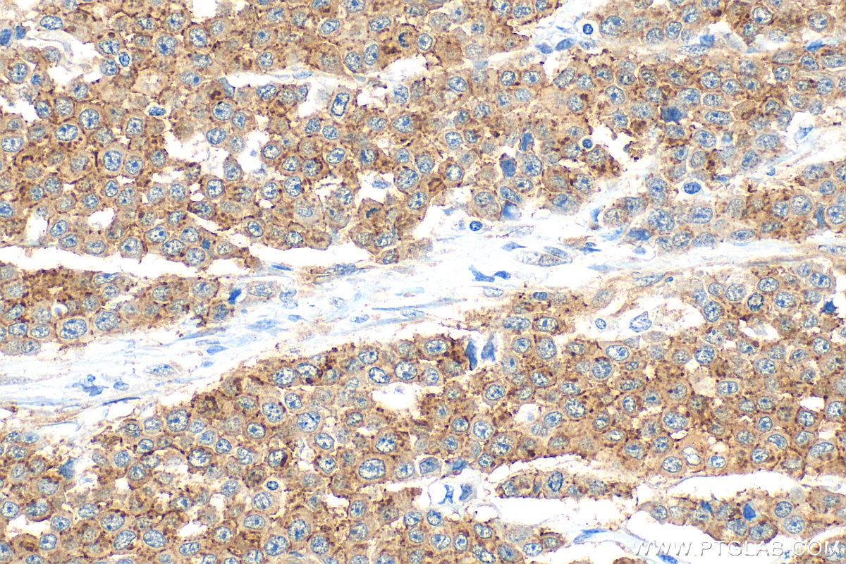 Immunohistochemistry (IHC) staining of human colon cancer tissue using GORASP2 Polyclonal antibody (10598-1-AP)