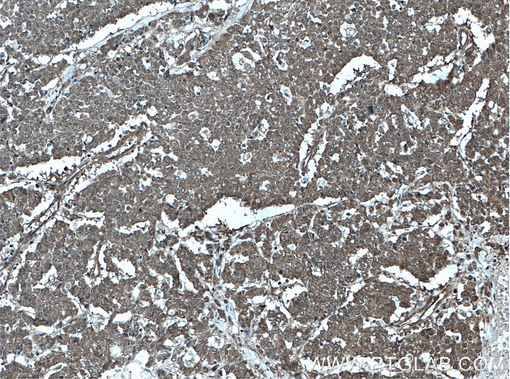 IHC staining of human colon cancer using 66627-1-Ig
