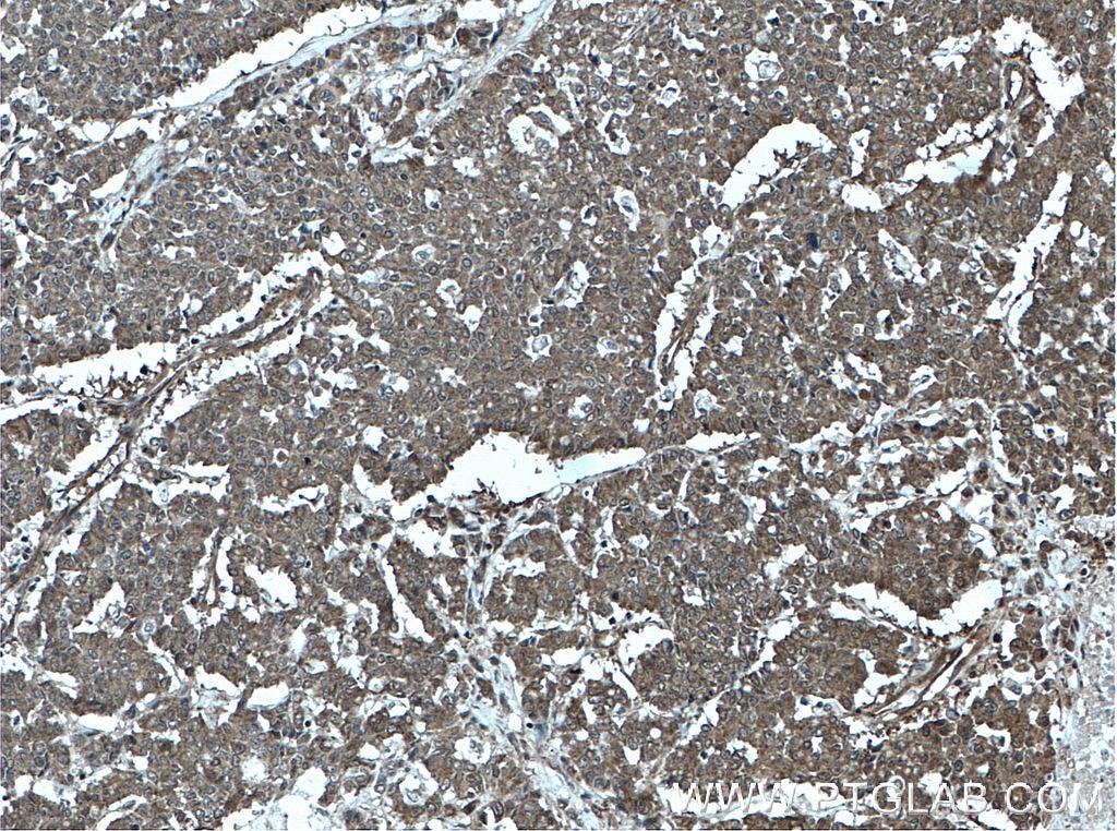 Immunohistochemistry (IHC) staining of human colon cancer tissue using GORASP2 Monoclonal antibody (66627-1-Ig)