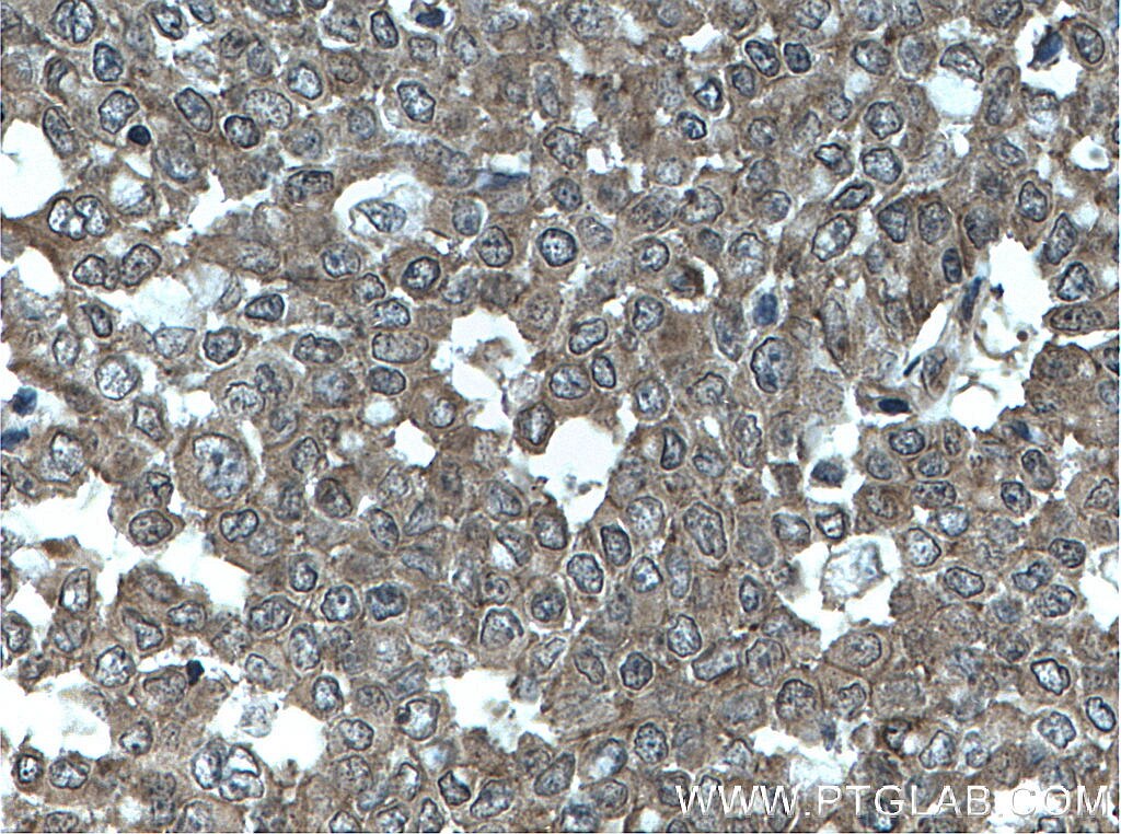 Immunohistochemistry (IHC) staining of human colon cancer tissue using GORASP2 Monoclonal antibody (66627-1-Ig)