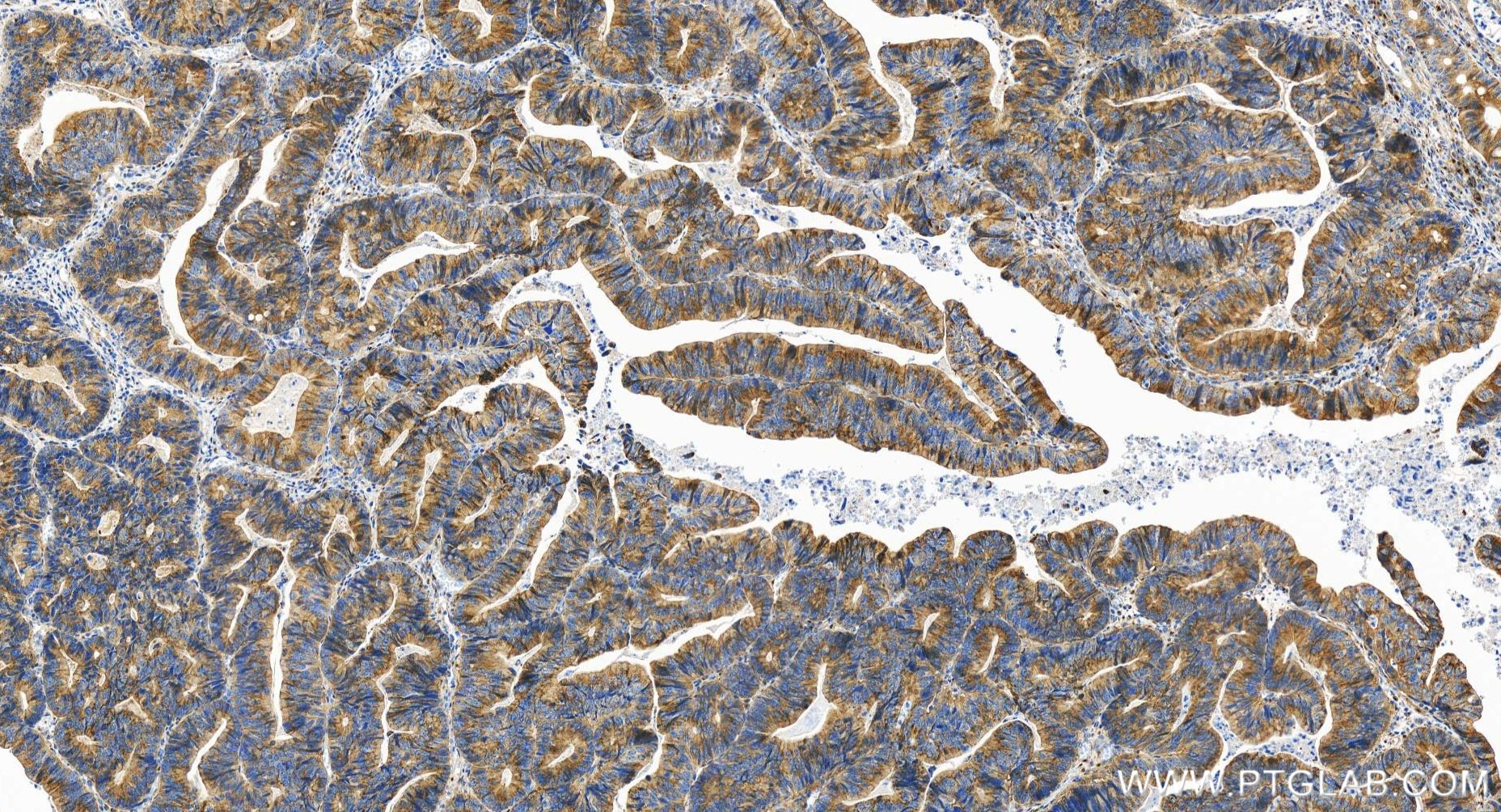 Immunohistochemistry (IHC) staining of human colon cancer tissue using GORASP2 Recombinant antibody (85077-5-RR)
