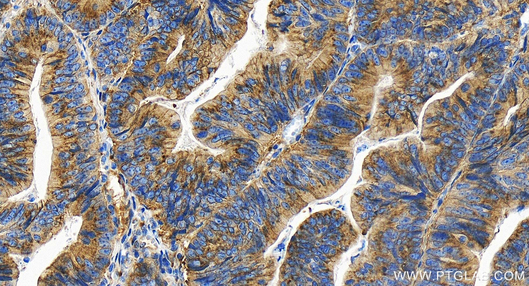 Immunohistochemistry (IHC) staining of human colon cancer tissue using GORASP2 Recombinant antibody (85077-5-RR)