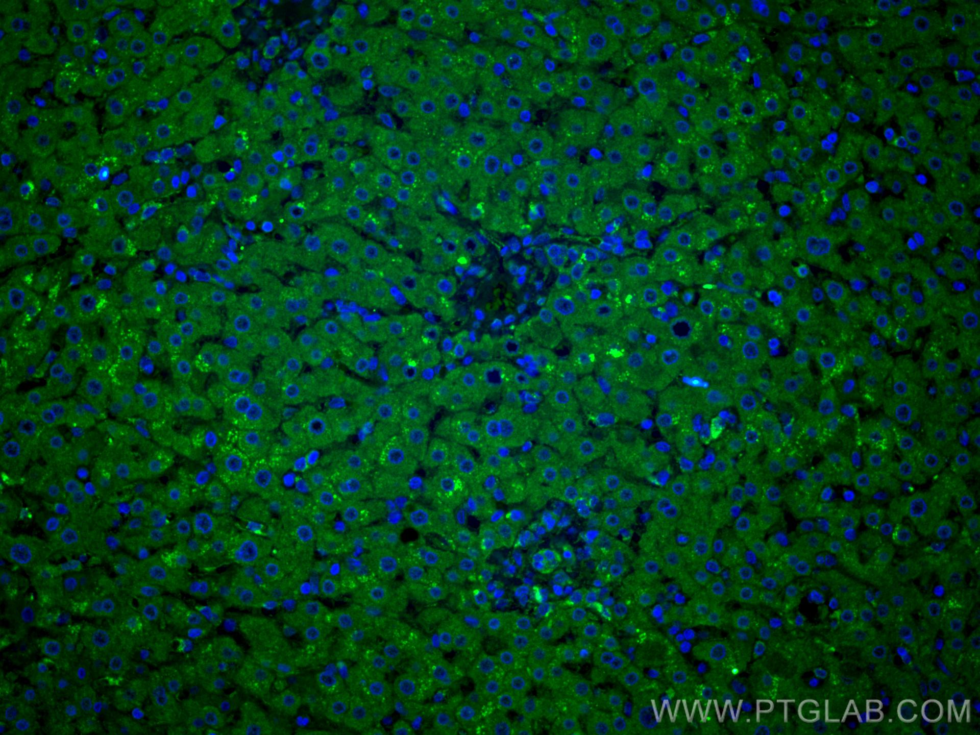 Immunofluorescence (IF) / fluorescent staining of human liver cancer tissue using GOSR2/Membrin Monoclonal antibody (66134-1-Ig)