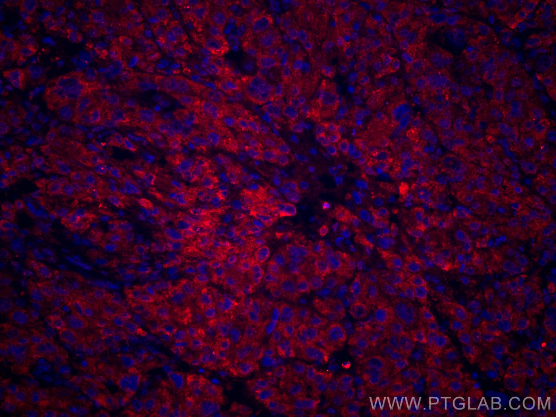 Immunofluorescence (IF) / fluorescent staining of human liver cancer tissue using CoraLite®594-conjugated GOSR2/Membrin Monoclonal a (CL594-66134)