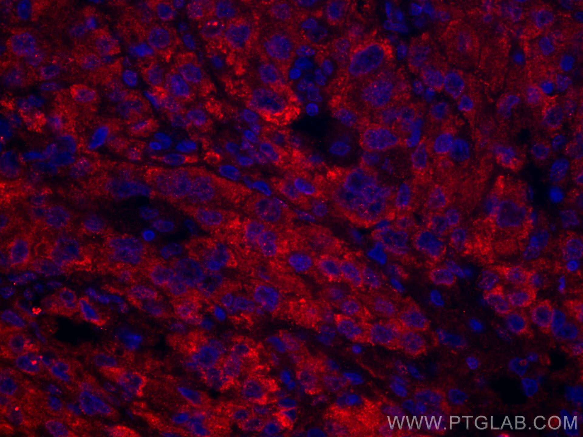 Immunofluorescence (IF) / fluorescent staining of human liver cancer tissue using CoraLite®594-conjugated GOSR2/Membrin Monoclonal a (CL594-66134)