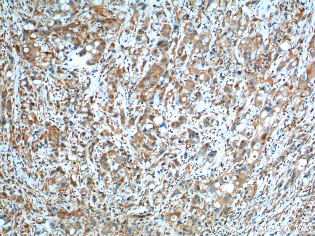 IHC staining of human liver cancer using 60317-1-Ig